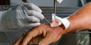 Discover five advanced wound care solutions that speed healing and prevent complications at Angeles Wound Care Institute in Bend, Oregon.