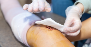 If you're asking "why won't my wound heal," Angeles Wound Care Institute provides expert diagnosis and personalized treatment plans to identify the root cause and achieve complete healing.